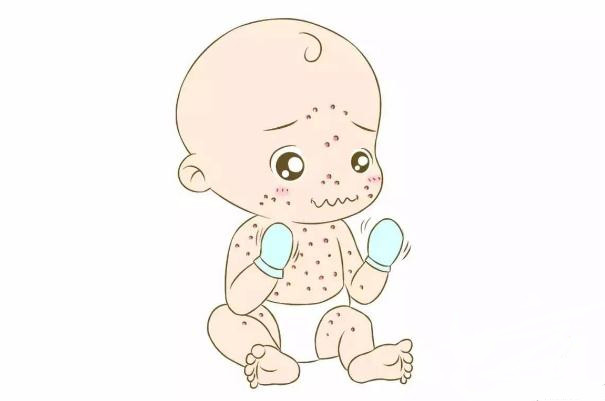 水痘會傳染給大人嗎 水痘會傳染給嬰兒嗎 水痘會傳染給大人嗎 水痘會傳染給嬰兒嗎