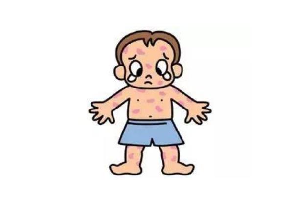 水痘有疫苗嗎 水痘有生命危險(xiǎn)嗎 水痘有疫苗嗎 水痘有生命危險(xiǎn)嗎