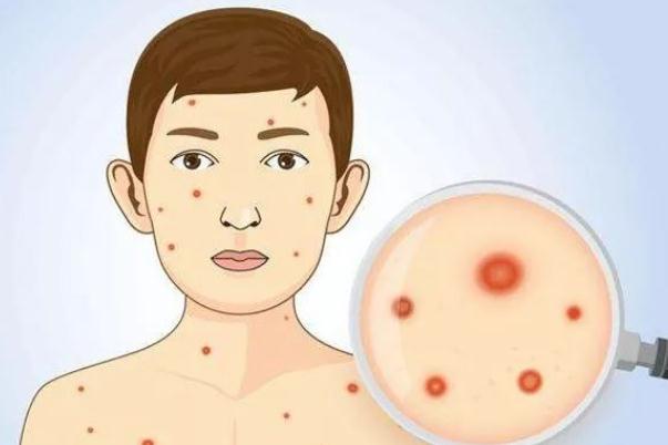 水痘一般第幾天停止長(zhǎng) 水痘一般多久可以痊愈 水痘一般第幾天停止長(zhǎng) 水痘一般多久可以痊愈