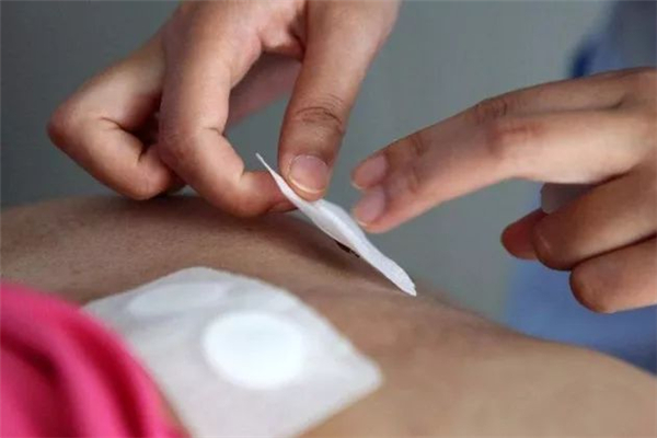 三伏貼可以祛濕嗎 三伏貼有什么作用和功效 三伏貼可以祛濕嗎 三伏貼有什么作用和功效