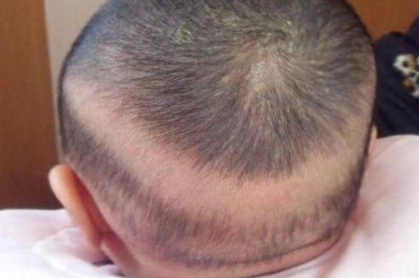 嬰兒枕禿是什么原因引起的 嬰兒枕禿什么時(shí)候能好 嬰兒枕禿是什么原因引起的 嬰兒枕禿什么時(shí)候能好
