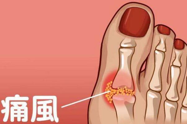 痛風(fēng)吃什么藥快速消腫止痛 痛風(fēng)如何簡(jiǎn)單預(yù)防 痛風(fēng)吃什么藥快速消腫止痛 痛風(fēng)如何簡(jiǎn)單預(yù)防