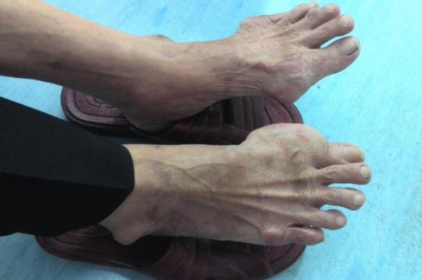 痛風(fēng)的人不能吃什么 痛風(fēng)的人吃什么最好 痛風(fēng)的人不能吃什么 痛風(fēng)的人吃什么最好