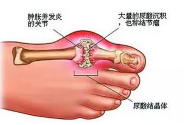 痛風(fēng)的人不能吃什么 痛風(fēng)的人吃什么最好 痛風(fēng)的人不能吃什么 痛風(fēng)的人吃什么最好