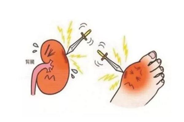 痛風要怎么才能徹底治好 痛風要看什么科室 痛風要怎么才能徹底治好 痛風要看什么科室