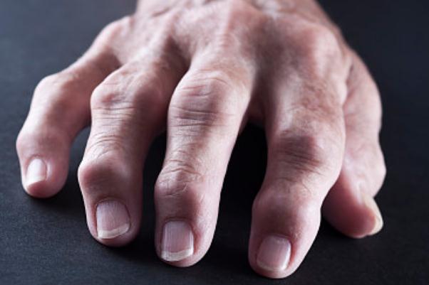 痛風(fēng)要做哪些檢查項(xiàng)目 痛風(fēng)有遺傳性嗎 痛風(fēng)要做哪些檢查項(xiàng)目 痛風(fēng)有遺傳性嗎