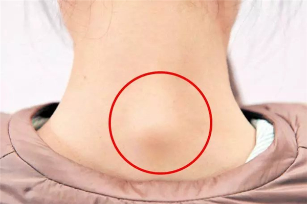 富貴包會(huì)引起耳鳴嗎 富貴包會(huì)引起腦供血不足嗎 富貴包會(huì)引起耳鳴嗎 富貴包會(huì)引起腦供血不足嗎