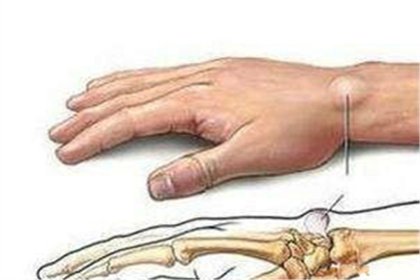 腱鞘炎都在什么部位的 腱鞘炎會(huì)導(dǎo)致手指腫脹嗎 腱鞘炎都在什么部位的 腱鞘炎會(huì)導(dǎo)致手指腫脹嗎