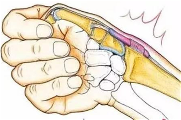 腱鞘炎會不會自愈 腱鞘炎會越來越腫嗎 腱鞘炎會不會自愈 腱鞘炎會越來越腫嗎