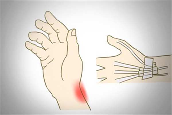 腱鞘炎都在什么部位的 腱鞘炎會(huì)導(dǎo)致手指腫脹嗎 腱鞘炎都在什么部位的 腱鞘炎會(huì)導(dǎo)致手指腫脹嗎