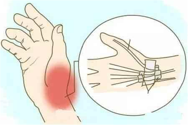 腱鞘炎會不會自愈 腱鞘炎會越來越腫嗎 腱鞘炎會不會自愈 腱鞘炎會越來越腫嗎