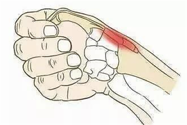 腱鞘炎對身體有什么危害 腱鞘炎對生活有影響嗎 腱鞘炎對身體有什么危害 腱鞘炎對生活有影響嗎