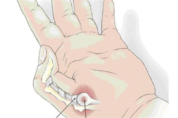 腱鞘炎是怎么形成的 腱鞘炎有什么癥狀 腱鞘炎是怎么形成的 腱鞘炎有什么癥狀