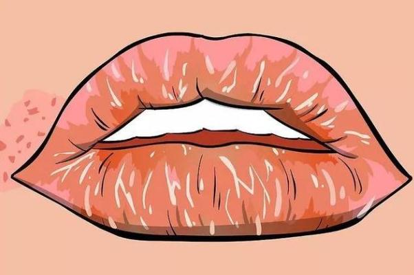 唇炎會傳染嗎 唇炎會自愈嗎 唇炎會傳染嗎 唇炎會自愈嗎