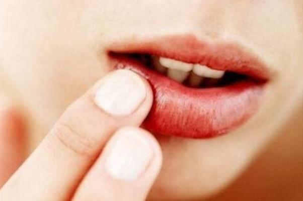 唇炎會傳染嗎 唇炎會自愈嗎 唇炎會傳染嗎 唇炎會自愈嗎