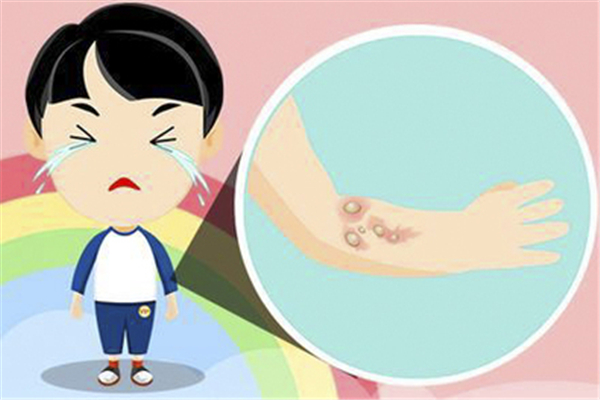 燙傷有幾種程度 燙傷屬于什么傷害 燙傷有幾種程度 燙傷屬于什么傷害