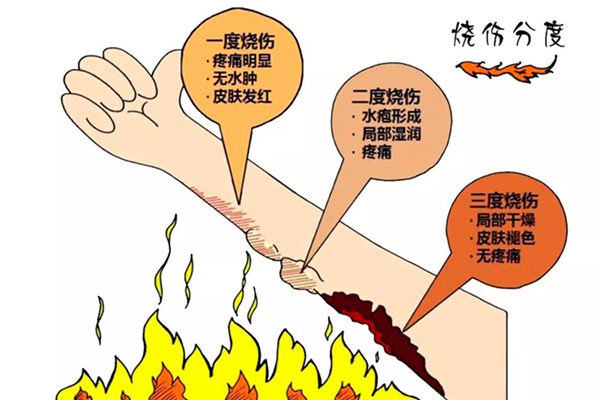 燙傷有幾種程度 燙傷屬于什么傷害