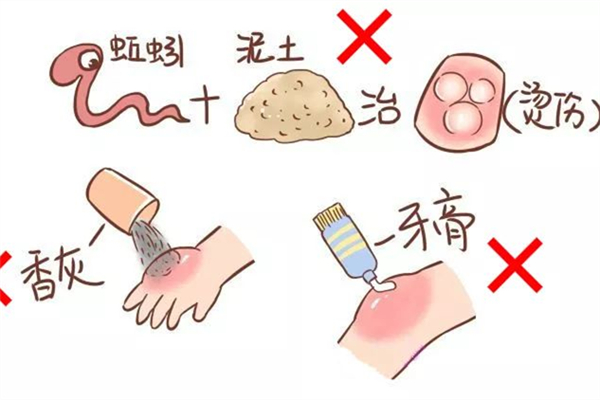 燙傷用牙膏有用嗎 燙傷最好處理方法