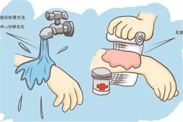 燙傷疼痛怎么辦 燙傷疼痛怎么緩解 燙傷疼痛怎么辦 燙傷疼痛怎么緩解