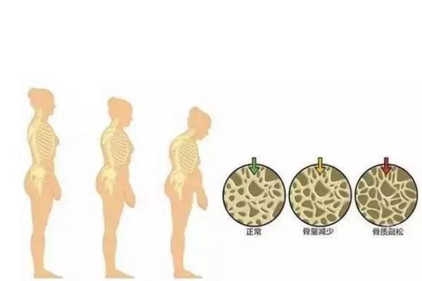 骨質(zhì)疏松是怎么回事 骨質(zhì)疏松是什么病 骨質(zhì)疏松是怎么回事 骨質(zhì)疏松是什么病