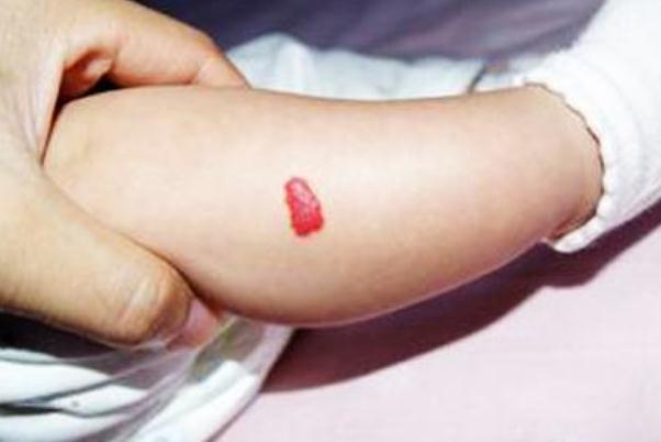 新生兒血管瘤的形成原因 新生兒血管瘤是很嚴(yán)重的病嗎 新生兒血管瘤的形成原因 新生兒血管瘤是很嚴(yán)重的病嗎