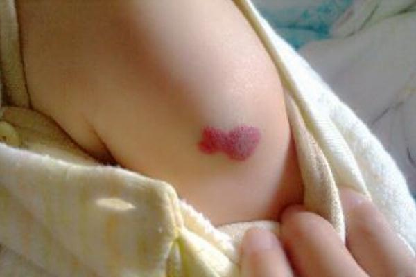 新生兒血管瘤怎么治 新生兒血管瘤是什么原因引起的 新生兒血管瘤怎么治 新生兒血管瘤是什么原因引起的