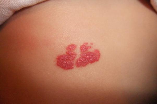 新生兒血管瘤怎么治 新生兒血管瘤是什么原因引起的 新生兒血管瘤怎么治 新生兒血管瘤是什么原因引起的