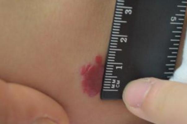 新生兒血管瘤能消退嗎 新生兒血管瘤治療費用大概多少 新生兒血管瘤能消退嗎 新生兒血管瘤治療費用大概多少