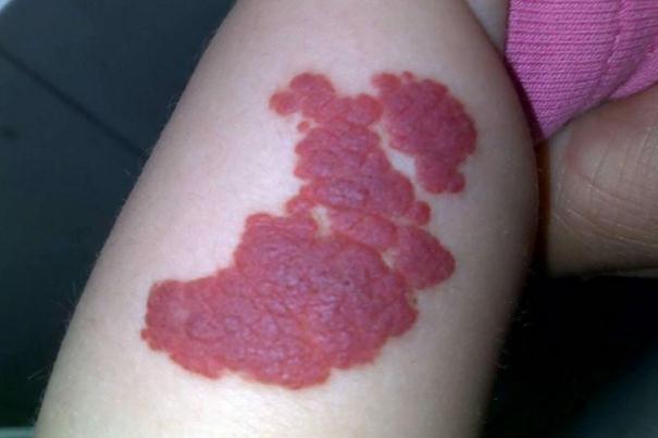 新生兒血管瘤有什么后遺癥嗎 新生兒血管瘤有幾種類型 新生兒血管瘤有什么后遺癥嗎 新生兒血管瘤有幾種類型