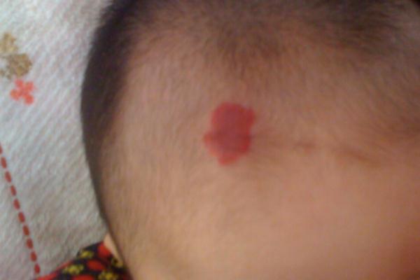 新生兒血管瘤能消退嗎 新生兒血管瘤治療費用大概多少 新生兒血管瘤能消退嗎 新生兒血管瘤治療費用大概多少