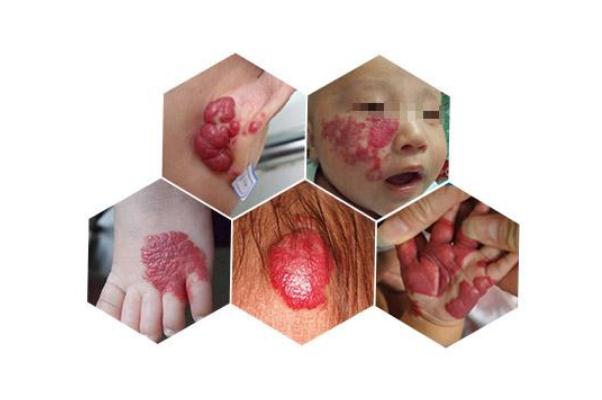 新生兒血管瘤怎么治 新生兒血管瘤是什么原因引起的 新生兒血管瘤怎么治 新生兒血管瘤是什么原因引起的