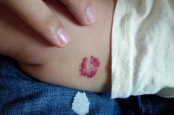 新生兒血管瘤能消退嗎 新生兒血管瘤治療費用大概多少 新生兒血管瘤能消退嗎 新生兒血管瘤治療費用大概多少