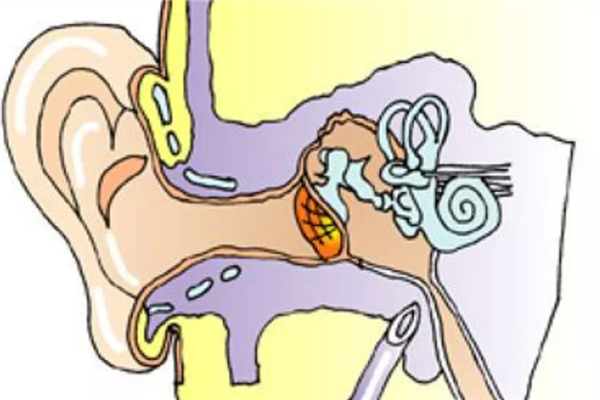 中耳炎流膿怎么辦 中耳炎流膿發(fā)臭嚴重嗎 中耳炎流膿怎么辦 中耳炎流膿發(fā)臭嚴重嗎