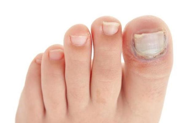 灰指甲會(huì)對(duì)胎兒有影響嗎 灰指甲對(duì)女性的危害性有哪些 灰指甲會(huì)對(duì)胎兒有影響嗎 灰指甲對(duì)女性的危害性有哪些