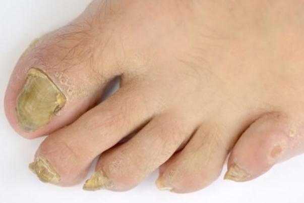 灰指甲有潛伏期嗎 灰指甲有什么癥狀 灰指甲有潛伏期嗎 灰指甲有什么癥狀