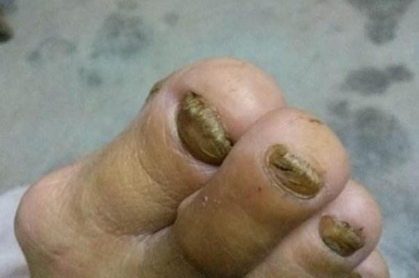 灰指甲會(huì)對(duì)胎兒有影響嗎 灰指甲對(duì)女性的危害性有哪些 灰指甲會(huì)對(duì)胎兒有影響嗎 灰指甲對(duì)女性的危害性有哪些