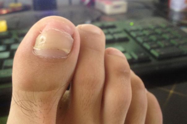 灰指甲要把整個指甲拔掉嗎 灰指甲要多久能治好 灰指甲要把整個指甲拔掉嗎 灰指甲要多久能治好