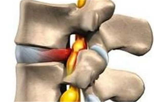 骨質(zhì)增生會(huì)壓迫神經(jīng)嗎 骨質(zhì)增生會(huì)越來(lái)越嚴(yán)重嗎 骨質(zhì)增生會(huì)壓迫神經(jīng)嗎 骨質(zhì)增生會(huì)越來(lái)越嚴(yán)重嗎