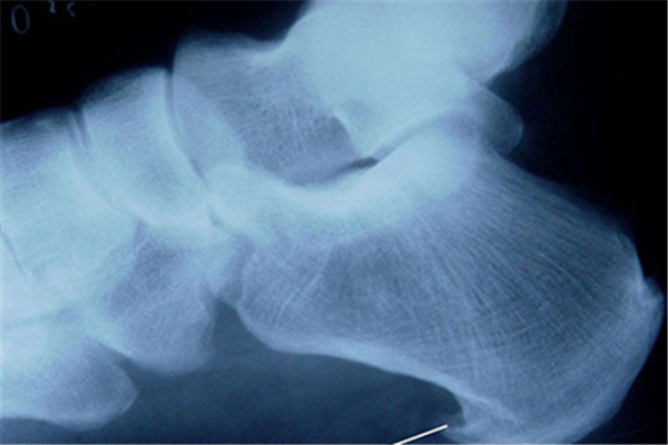 骨質(zhì)增生是缺鈣嗎 骨質(zhì)增生是缺什么營養(yǎng)嗎 骨質(zhì)增生是缺鈣嗎 骨質(zhì)增生是缺什么營養(yǎng)嗎