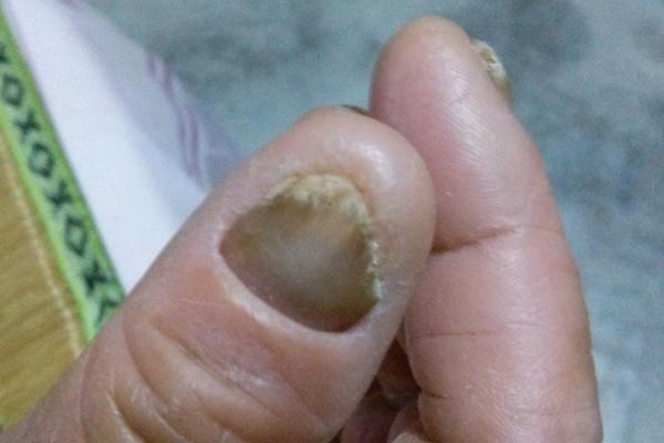 灰指甲會(huì)對(duì)胎兒有影響嗎 灰指甲對(duì)女性的危害性有哪些 灰指甲會(huì)對(duì)胎兒有影響嗎 灰指甲對(duì)女性的危害性有哪些