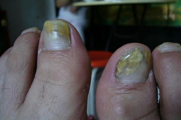 灰指甲會(huì)不會(huì)傳染別人 灰指甲會(huì)疼痛嗎 灰指甲會(huì)不會(huì)傳染別人 灰指甲會(huì)疼痛嗎