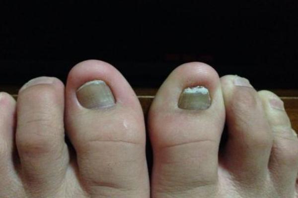 灰指甲要把整個指甲拔掉嗎 灰指甲要多久能治好 灰指甲要把整個指甲拔掉嗎 灰指甲要多久能治好