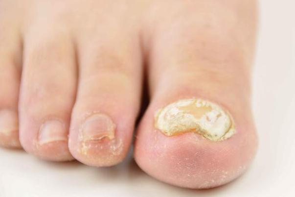 灰指甲要把整個指甲拔掉嗎 灰指甲要多久能治好 灰指甲要把整個指甲拔掉嗎 灰指甲要多久能治好