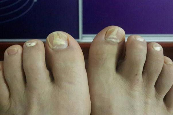 灰指甲有異味嗎 灰指甲有沒有傳染性 灰指甲有異味嗎 灰指甲有沒有傳染性