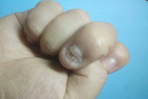 灰指甲會(huì)不會(huì)傳染別人 灰指甲會(huì)疼痛嗎 灰指甲會(huì)不會(huì)傳染別人 灰指甲會(huì)疼痛嗎