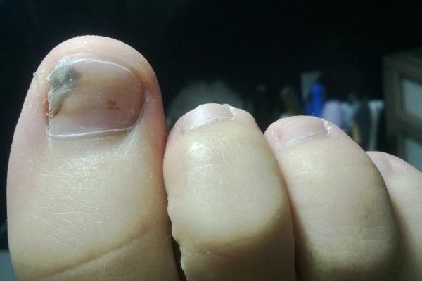灰指甲的危害性有哪些 灰指甲是怎么引起的 灰指甲的危害性有哪些 灰指甲是怎么引起的