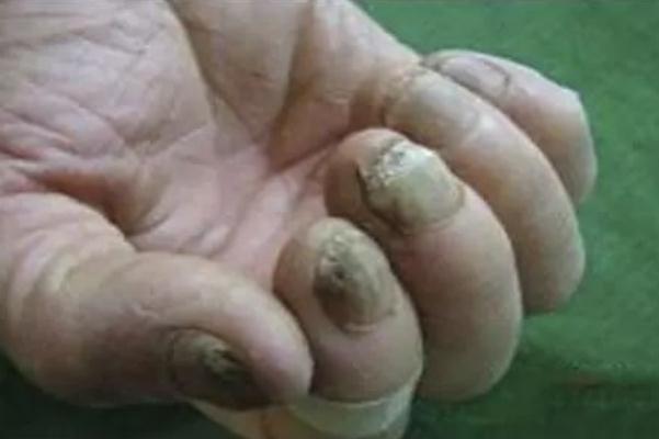 灰指甲有異味嗎 灰指甲有沒有傳染性 灰指甲有異味嗎 灰指甲有沒有傳染性