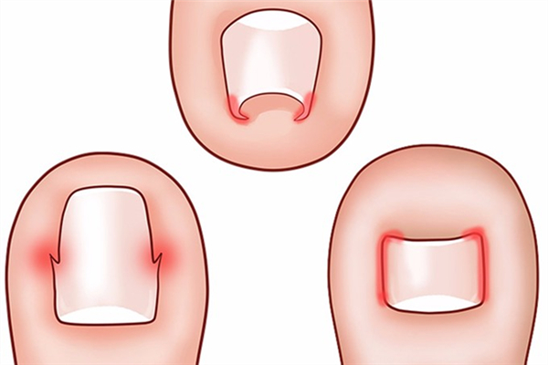 甲溝炎自己化膿了怎么處理 甲溝炎化膿怎么治療最好 甲溝炎自己化膿了怎么處理 甲溝炎化膿怎么治療最好