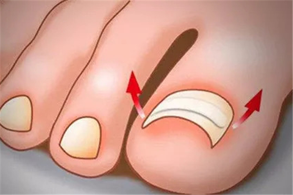 甲溝炎指甲長出來就好了嗎 甲溝炎指甲長肉里好深怎么辦 甲溝炎指甲長出來就好了嗎 甲溝炎指甲長肉里好深怎么辦