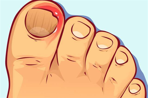 甲溝炎拔掉指甲后如何處理 甲溝炎拔指甲會(huì)不會(huì)痛 甲溝炎拔掉指甲后如何處理 甲溝炎拔指甲會(huì)不會(huì)痛